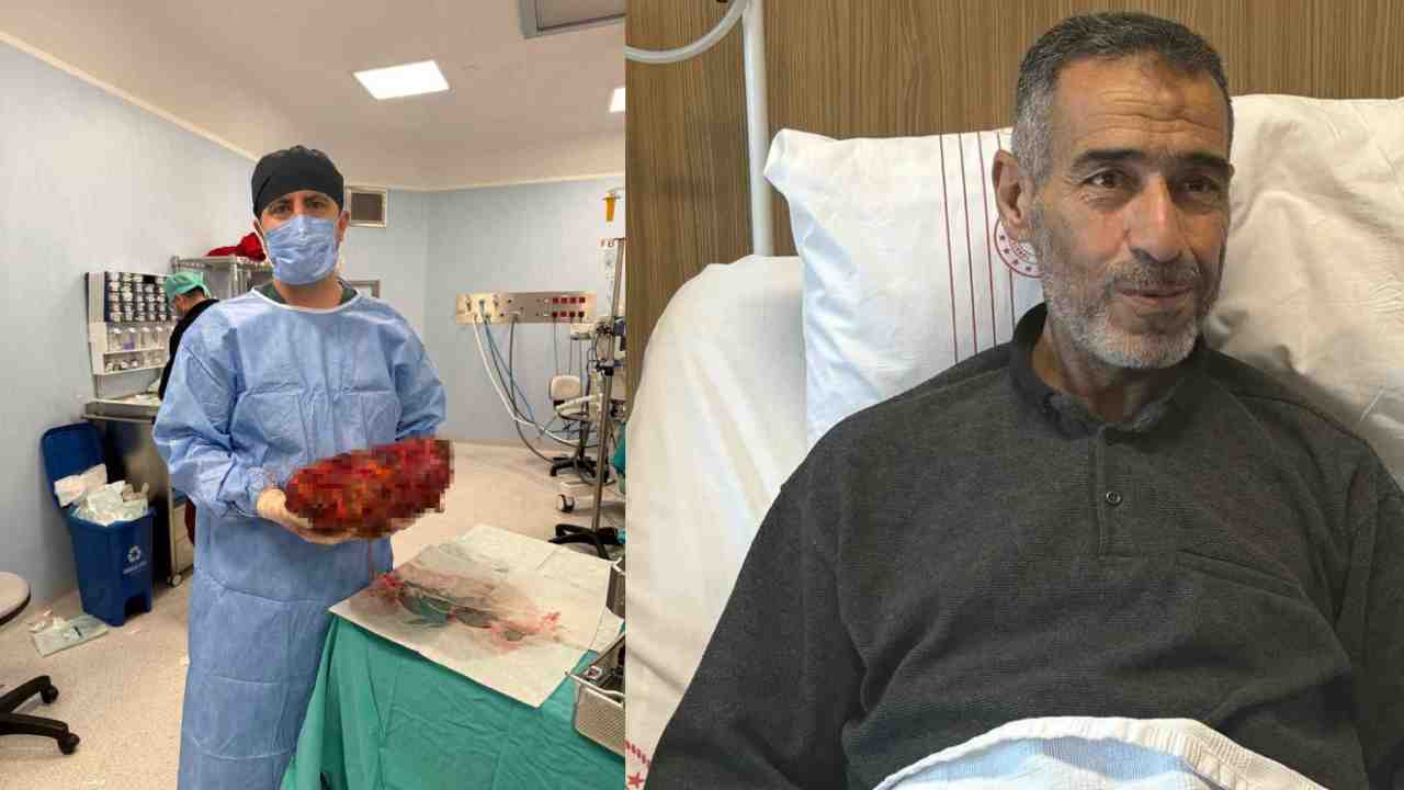 8 Kiloluk Böbrek Ameliyatla Alındı, Sağlığına Kavuştu!
